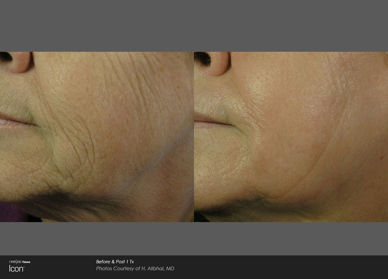 wrinkle removal - skin renewal